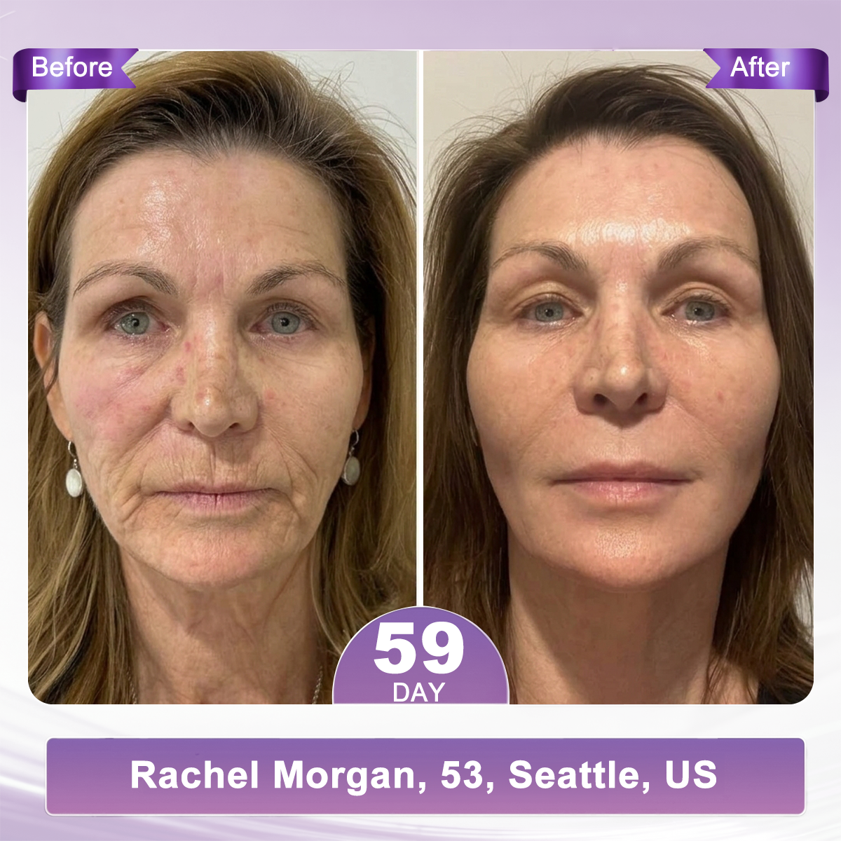🔥 𝐖𝐫𝐢𝐧𝐤𝐥𝐞 𝐑𝐞𝐩𝐚𝐢𝐫 & 𝐒𝐤𝐢𝐧 𝐑𝐞𝐧𝐞𝐰𝐚𝐥 𝐂𝐫𝐞𝐚𝐦 — 𝐒𝐏𝐄𝐂𝐈𝐀𝐋 𝐁𝐎𝐍𝐔𝐒 𝐔𝐍𝐋𝐎𝐂𝐊𝐄𝐃! 𝟖𝟎% 𝐎𝐅𝐅 𝐇𝐈𝐒𝐊𝐈𝐍® | 𝐒𝐦𝐨𝐨𝐭𝐡 𝐅𝐢𝐧𝐞 𝐋𝐢𝐧𝐞𝐬, 𝐑𝐞𝐩𝐚𝐢𝐫 𝐒𝐤𝐢𝐧 𝐀𝐟𝐭𝐞𝐫 𝐒𝐩𝐨𝐭 𝐂𝐚𝐫𝐞 & 𝐑𝐞𝐯𝐞𝐚𝐥 𝐅𝐢𝐫𝐦𝐞𝐫, 𝐘𝐨𝐮𝐭𝐡𝐟𝐮𝐥-𝐋𝐨𝐨𝐤𝐢𝐧𝐠 𝐒𝐤𝐢𝐧