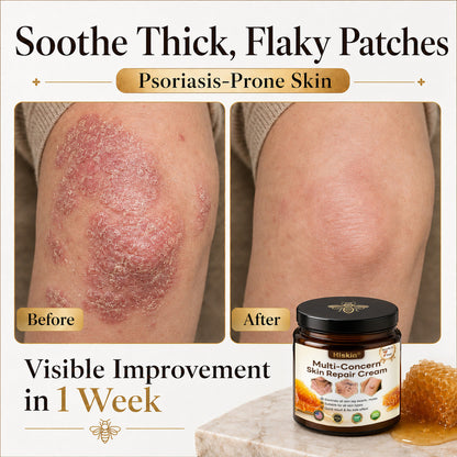 🔥 DON’T STOP AFTER SPOT CARE — Give Your Skin The Long-Term Care It Deserves With This Exclusive HISKIN® Repair Cream Upgrade!