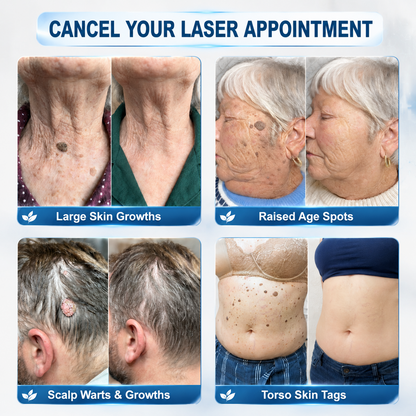 𝐇𝐈𝐒𝐊𝐈𝐍®👩‍⚕️ 𝟕-𝐃𝒂𝘆 𝐒𝗸𝐢𝐧 𝐓𝒂𝗴 & 𝐒𝐩𝙤𝐭 𝐄𝐫𝒂𝐬𝙚𝐫 𝐏𝐚𝐢𝐧𝐥𝐞𝐬𝐬 & 𝐒𝐜𝐚𝐫-𝐅𝐫𝐞𝐞 𝐀𝐝𝐯𝐚𝐧𝐜𝐞𝐝 𝐈𝐦𝐩𝐞𝐫𝐟𝐞𝐜𝐭𝐢𝐨𝐧 𝐑𝐞𝐦𝐨𝐯𝐚𝐥 𝐑𝐨𝐥𝐥𝐞𝐫𝐛𝐚𝐥𝐥 𝐏𝐞𝐧