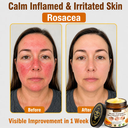 🔥 DON’T STOP AFTER SPOT CARE — Give Your Skin The Long-Term Care It Deserves With This Exclusive HISKIN® Repair Cream Upgrade!