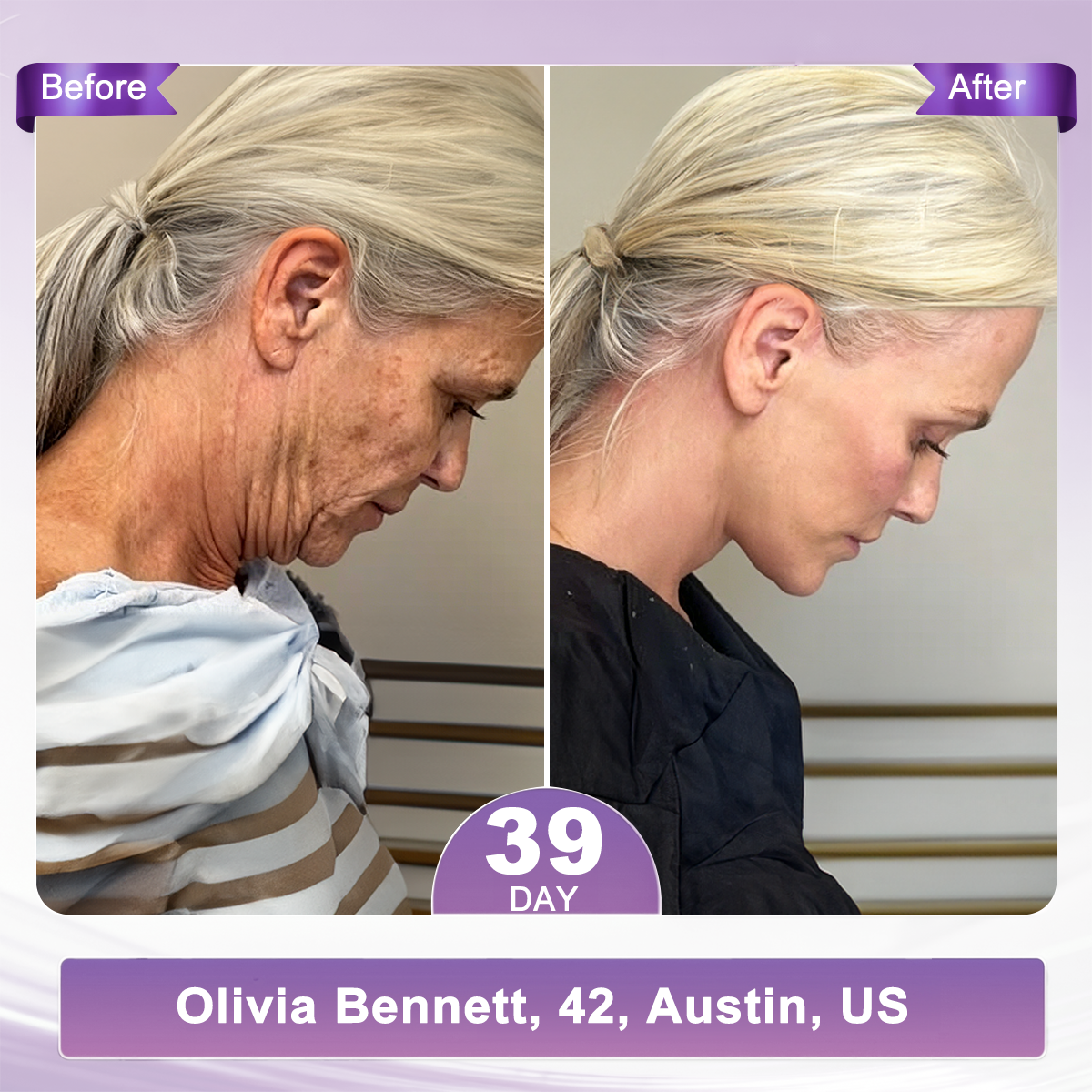 🔥 𝐖𝐫𝐢𝐧𝐤𝐥𝐞 𝐑𝐞𝐩𝐚𝐢𝐫 & 𝐒𝐤𝐢𝐧 𝐑𝐞𝐧𝐞𝐰𝐚𝐥 𝐂𝐫𝐞𝐚𝐦 — 𝐒𝐏𝐄𝐂𝐈𝐀𝐋 𝐁𝐎𝐍𝐔𝐒 𝐔𝐍𝐋𝐎𝐂𝐊𝐄𝐃! 𝟖𝟎% 𝐎𝐅𝐅 𝐇𝐈𝐒𝐊𝐈𝐍® | 𝐒𝐦𝐨𝐨𝐭𝐡 𝐅𝐢𝐧𝐞 𝐋𝐢𝐧𝐞𝐬, 𝐑𝐞𝐩𝐚𝐢𝐫 𝐒𝐤𝐢𝐧 𝐀𝐟𝐭𝐞𝐫 𝐒𝐩𝐨𝐭 𝐂𝐚𝐫𝐞 & 𝐑𝐞𝐯𝐞𝐚𝐥 𝐅𝐢𝐫𝐦𝐞𝐫, 𝐘𝐨𝐮𝐭𝐡𝐟𝐮𝐥-𝐋𝐨𝐨𝐤𝐢𝐧𝐠 𝐒𝐤𝐢𝐧